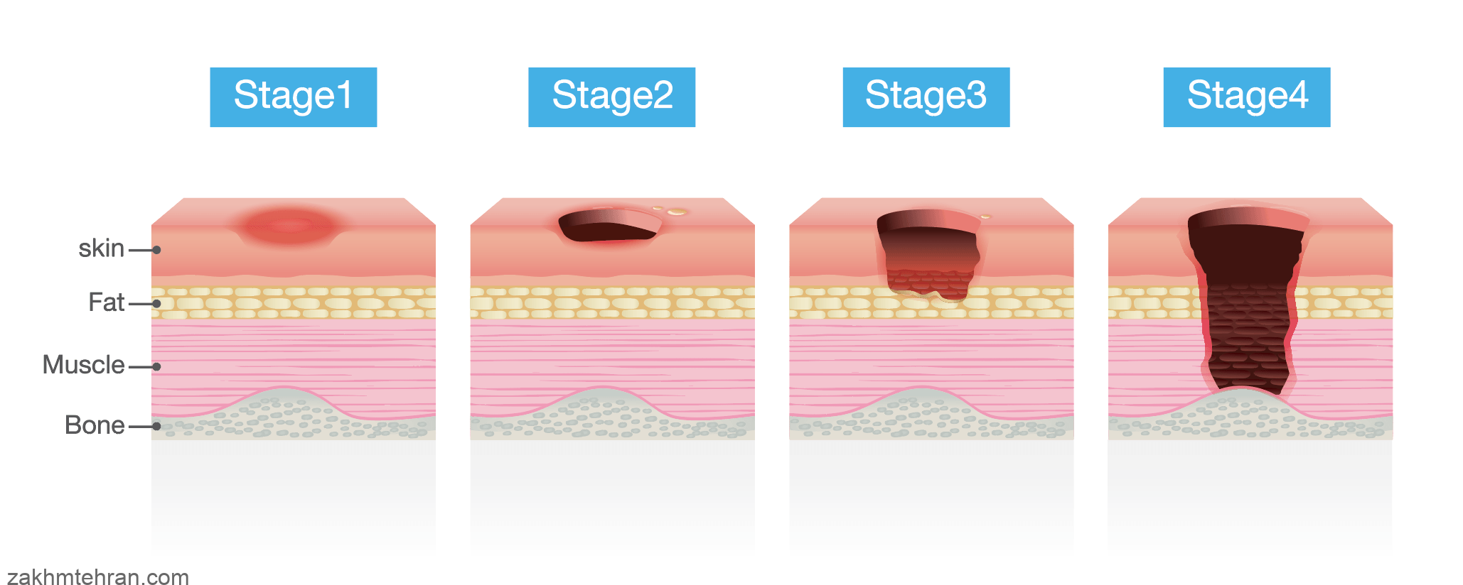 درمان زخم بستر - کلینیک زخم تهران - وحید فرجی